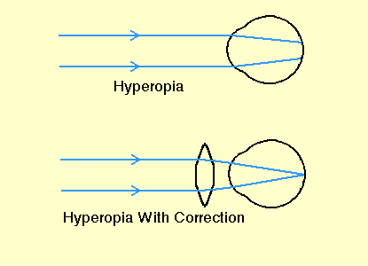 hyperpia correction.gif